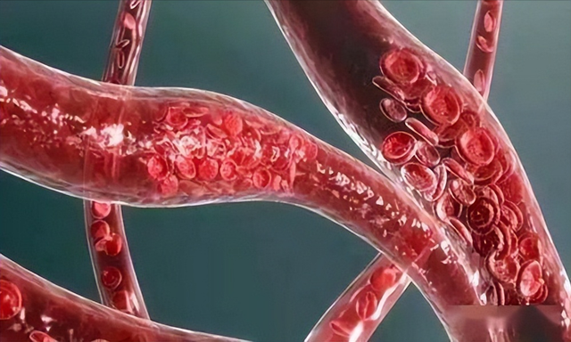 双脚一旦出现4种异常，十有八九是血管堵了，拖久了会变成大病