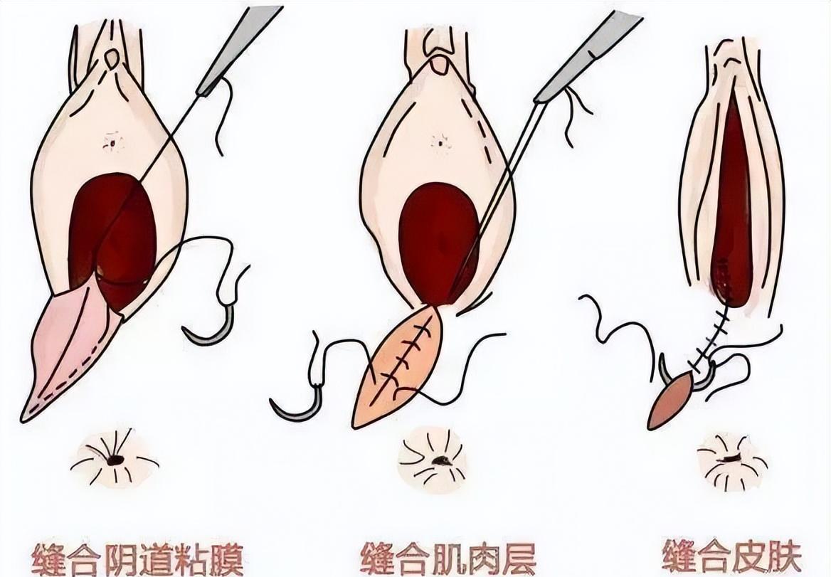 因嫌弃红包给的太少,医院竟将产妇G门缝合?真相十年后才揭开!