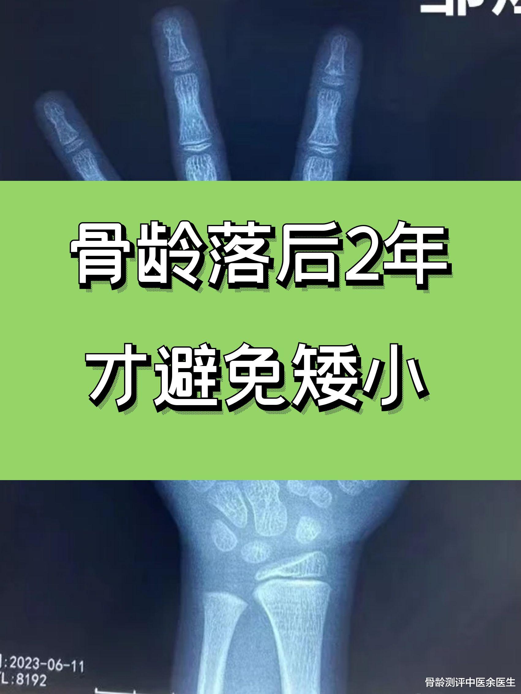 |骨龄落后2年才避免矮小