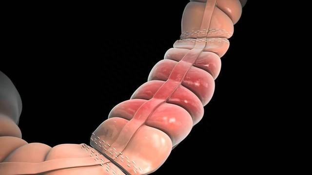 医生：肠道里长了息肉，上厕所时会有3个提示，别等到晚期才知晓