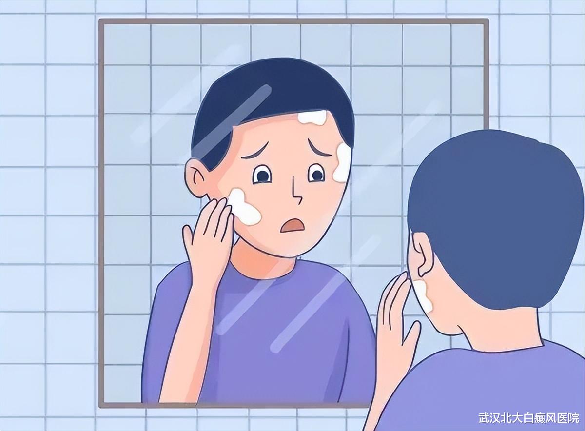 炎症会加重白癜风病情,生活中要小心这5种炎症