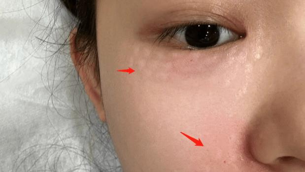 林允|27岁林允主动分享医美过程，脸上被扎满针眼，网友：真实又勇敢