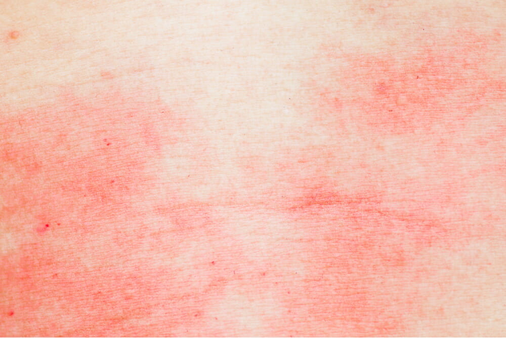 皮炎|Tapinarof乳膏可缓解小至2岁患者的特应性皮炎