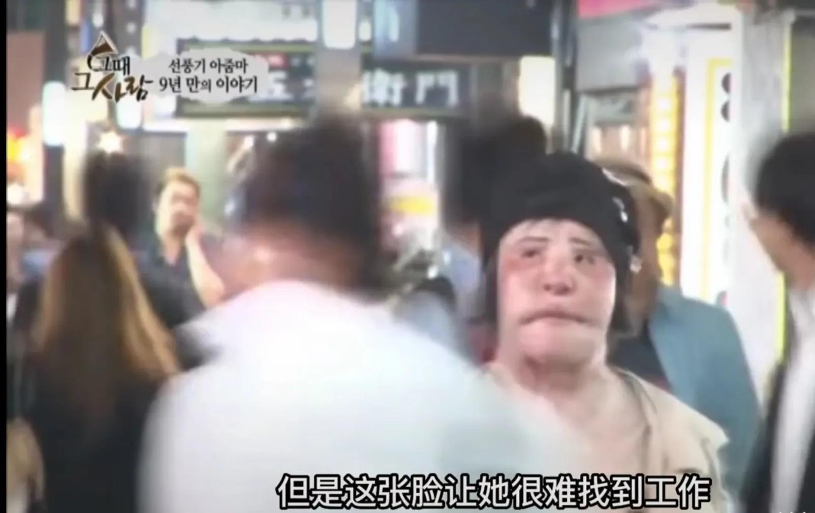 韩慧景|28岁女歌星整容成瘾!缺钱整容自己动手:脸上注射香油和水泥!