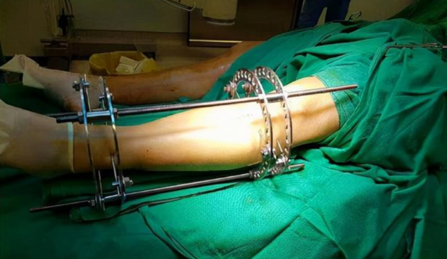 医生|花了家里16万切断双腿骨头，只为增高7.2厘米，如今与后遗症为伴