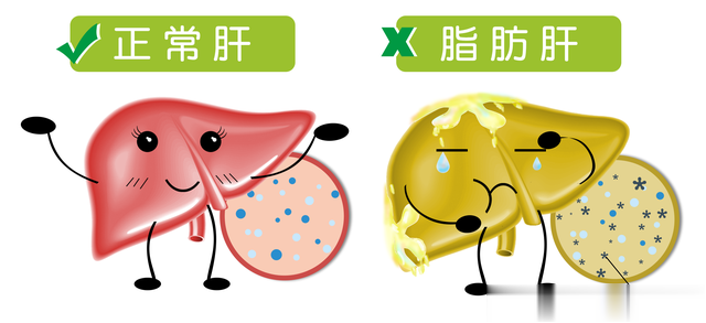 细数脂肪肝的4大症型，你属于哪一个？分享4个方子，从源头治起