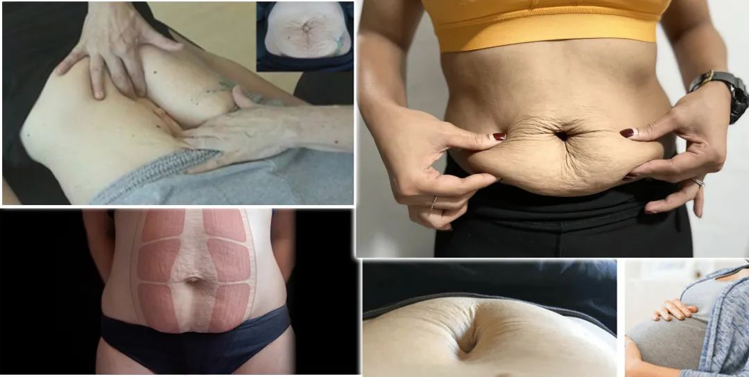 |被“掰开”的腹肌，腹直肌分离怎么办？3个动作让你自我检测