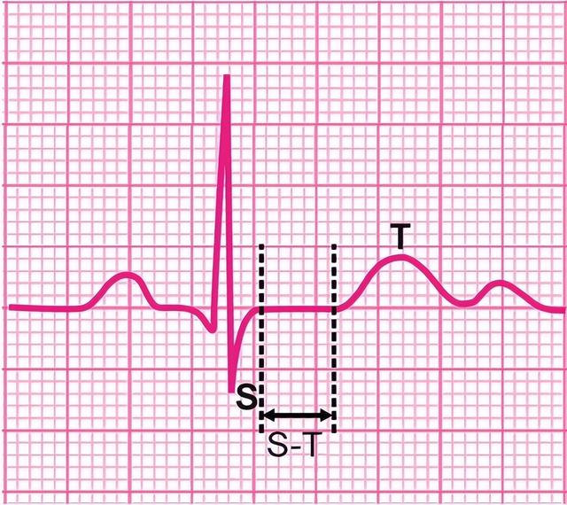 检查报告上这几种“异常”，无需太担心