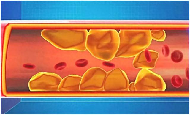 56岁男子坚持不吃晚饭，清除斑块、软化血管，6个月后效果如何？