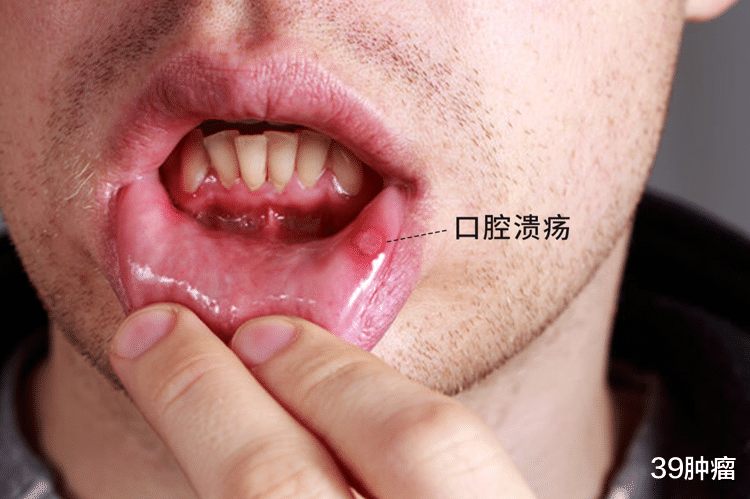 口腔癌|体内有癌，嘴先知？提醒：口腔出现这4种迹象，可能是癌症在靠近
