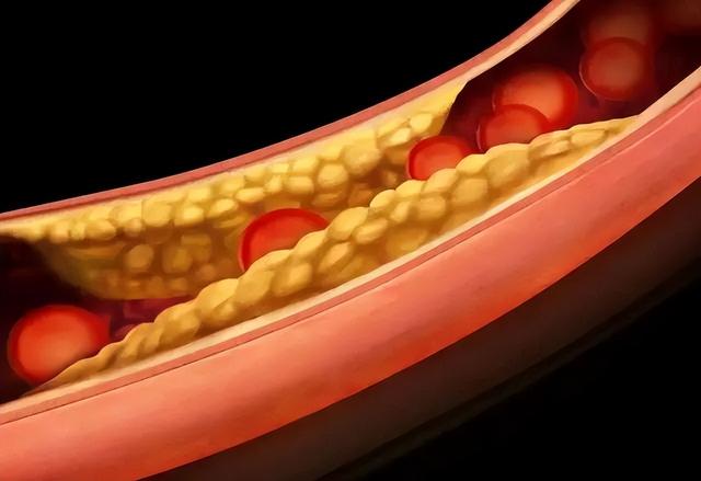 血压145/95发生了脑梗塞，为什么160/100的人却没事？早知早受益