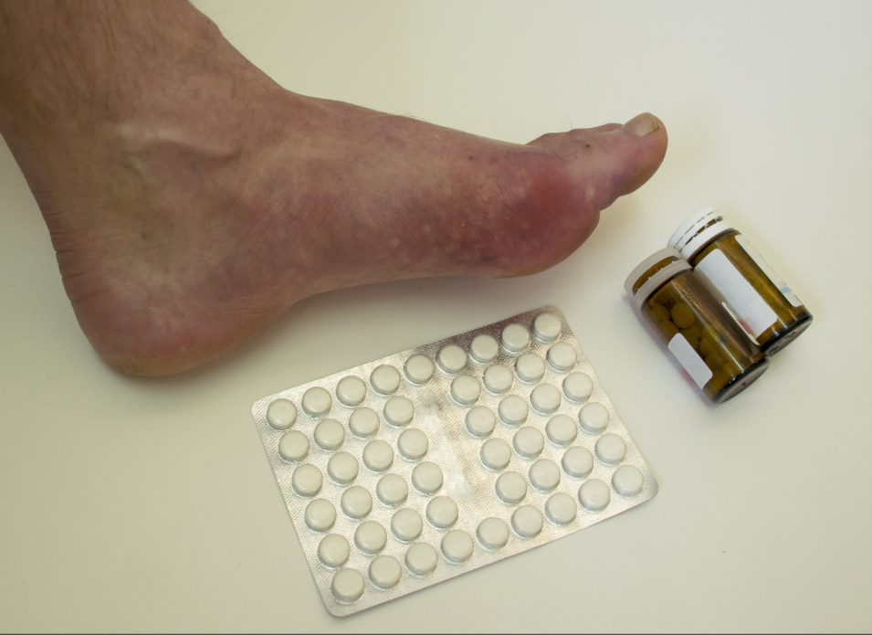 有痛风的人，需谨记：5类食物升尿酸，别碰，6类食物降尿酸，常吃