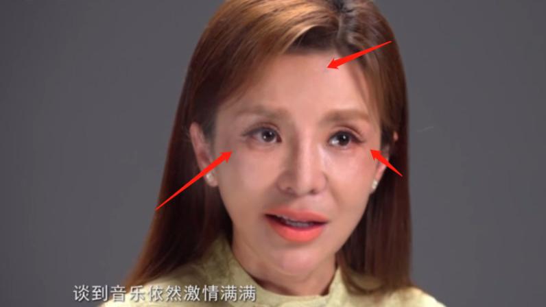朱迅录节目被疑整容失败！面部坑洼出现黑斑，网友：央视没人了？