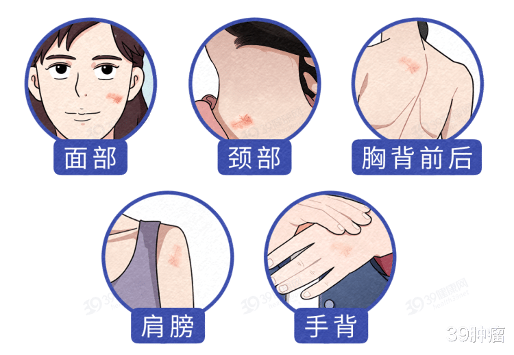 身上的痣有好坏！长在3个部位的痣，或与癌症密切相关，尽早处理