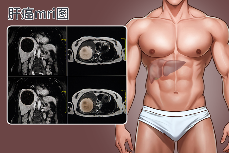 全球近一半肝癌在中国，提醒：家中的这3种食物，尽早撤下餐桌！