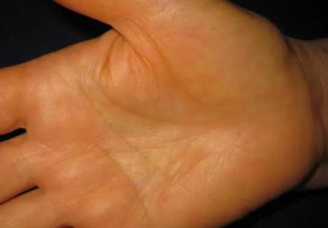 肝脏发出预警时，“手上”会有5个信号，有一个，建议尽快做肝CT