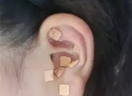 针灸减肥原理与注意事项