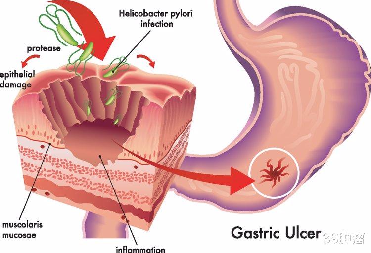 柳叶刀:中国胃癌最大的祸根是幽门螺杆菌,牢记3个办法彻底消灭