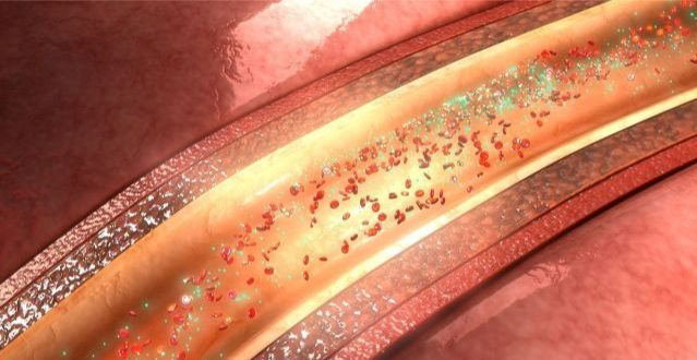 高血脂|血脂高的人，除了少吃肉，还有4种“素食”也要少吃，早做了解