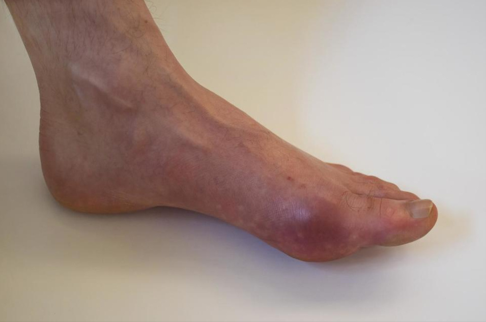 豆制品是痛风的“催化剂”？提醒：该少吃的是4种食物，早做了解