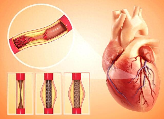 装上心脏支架后，还能活多少年？医生不再隐瞒，说出答案