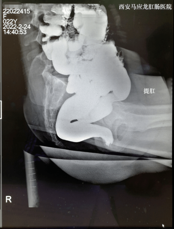 慢性便秘的排粪造影检查怎么做? - 健康资讯(主打网)