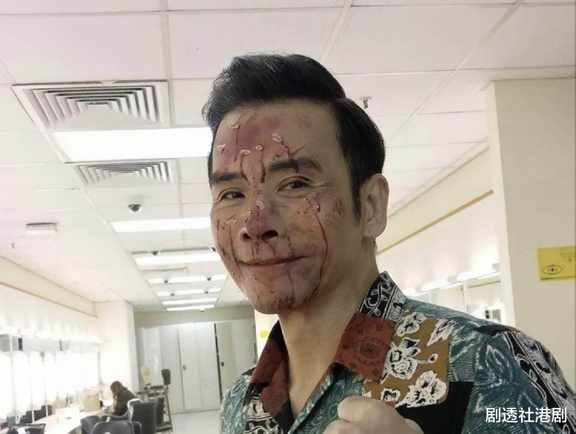 林伟|TVB知名男星疑患病,近照面颊凹陷身材消瘦,割胆手术致气血不足