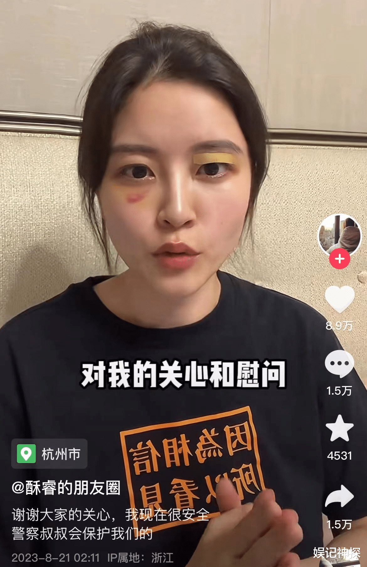曝好声音学员酥睿力挺李玟!发声后却鼻青脸肿,网友喊话胡锡进主持公道