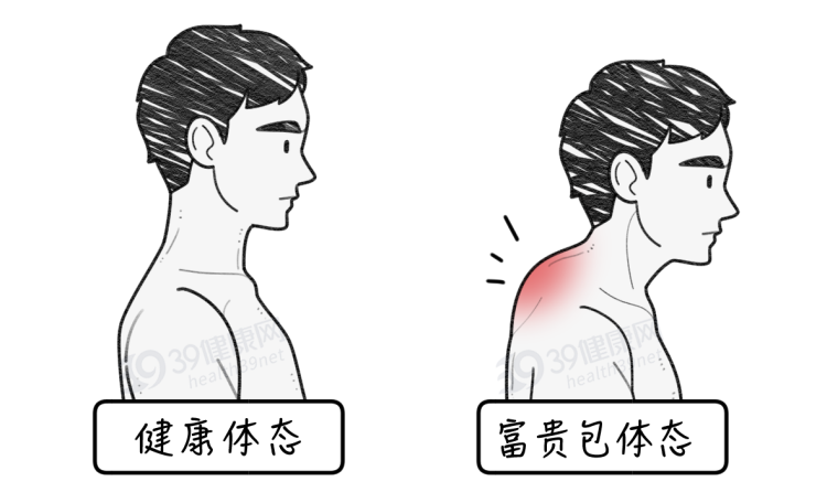 肿瘤|体内有癌，脖子先知？颈部若出现5种异常表现，可能是癌症在靠近