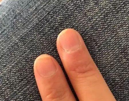 银屑病|银屑病指甲太受伤，病友群里秀指甲才发现很多被误诊