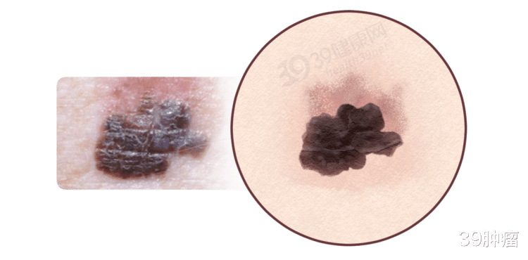 身上的痣有好坏！长在3个部位的痣，或与癌症密切相关，及时处理