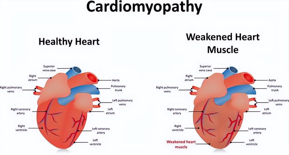 运动员为何会容易猝死?日常这3件事,同样也对心脏健康无益!