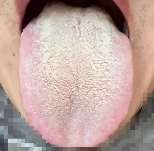 湿气就像催命符，中医绝招，刮除寒湿，湿热，痰湿，湿气一扫光