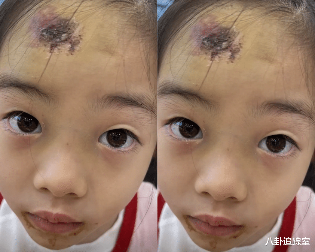 赌王|杨威幼女意外受伤,被自行车压住,额头乌青流血膝盖包扎一声不吭