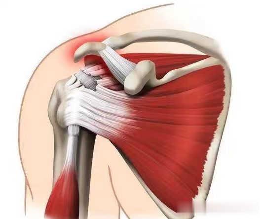 熬夜|肩膀疼痛是怎么回事?本文告知您6种病因,让您再也不盲目咨询