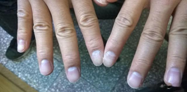 肾“衰”手先知,手上出现这五种“丑象”,肾脏可能已被“掏空”