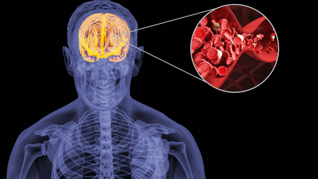 血常规|脑梗是“吃”出来的?劝告:3种食物易堵塞血管,再爱吃也别贪嘴