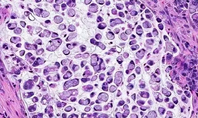 每天连吃三顿,39岁二孩爸爸确诊癌症晚期!这菜很多人都爱吃