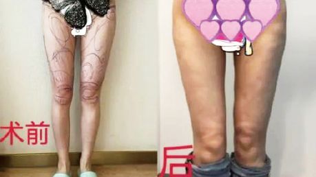女子吸脂后致腹部凹陷双腿畸形 律师建议：可申请法院进行鉴定