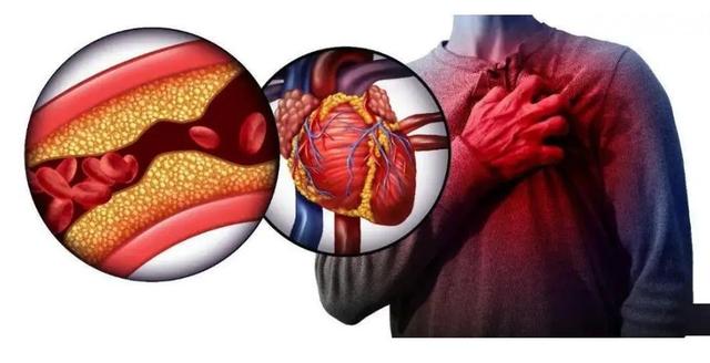 48岁男子胸痛3天，对妻子说换了衣服后就去医院，最后被宣布死亡