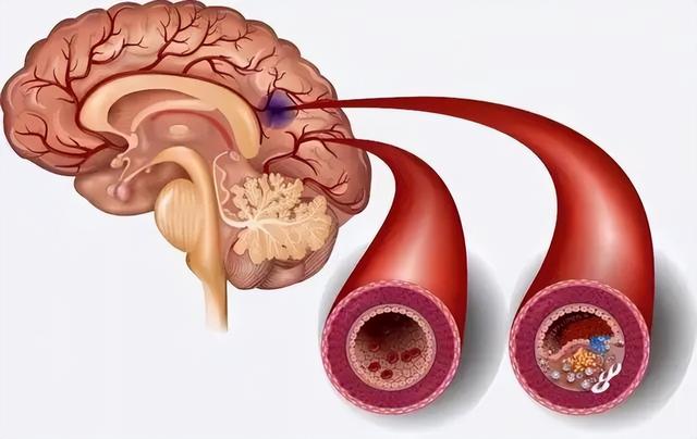 血压145/95发生了脑梗塞，为什么160/100的人却没事？早知早受益