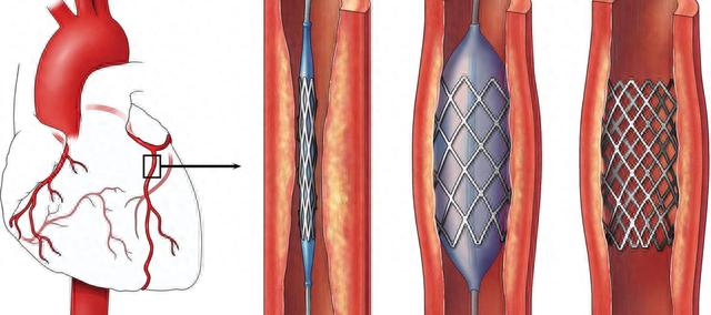 国内将停止心脏支架手术？心脏支架手术是利大还是弊大？科普真相