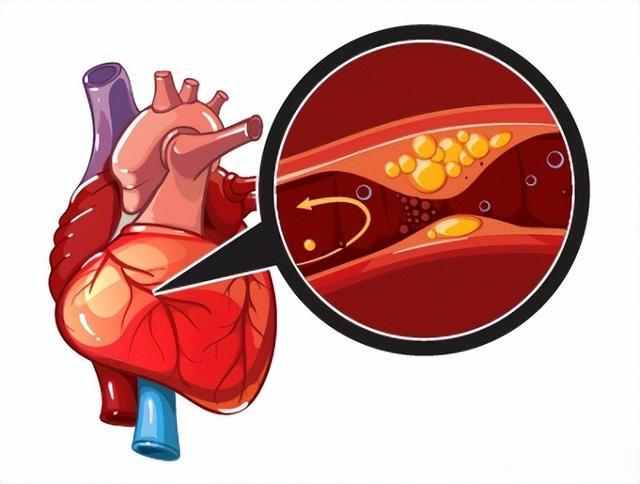 一个中成药，堪比血管中的清道夫，血瘀没有了，痰浊不见了