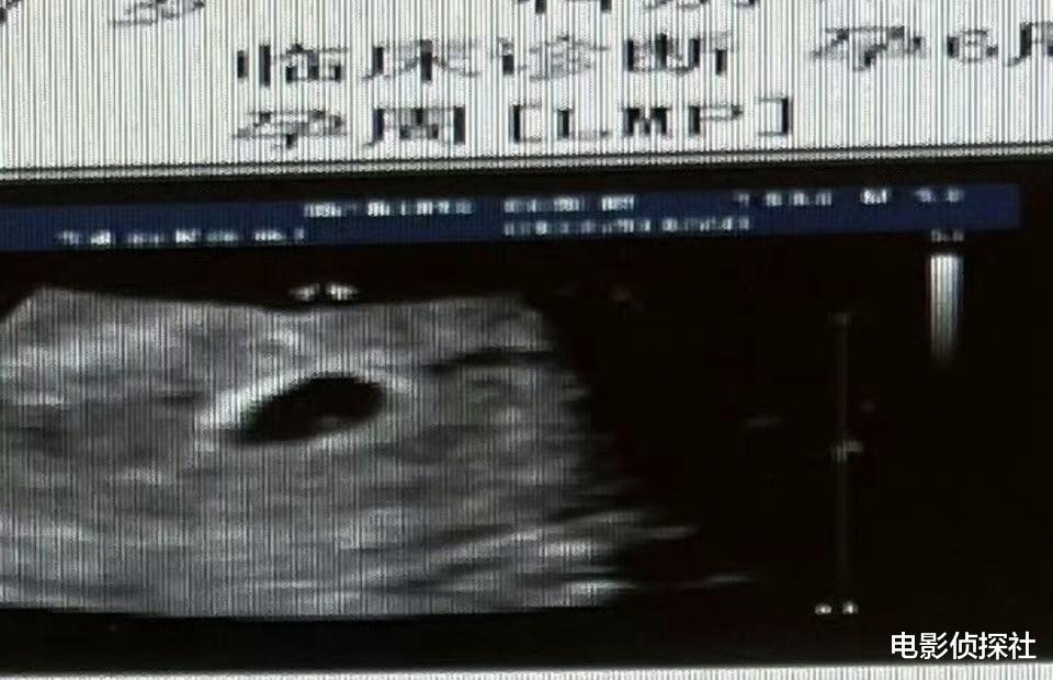 大瓜!知名娱记曝B超单后秒删,再次发文称尊重当事人的意见