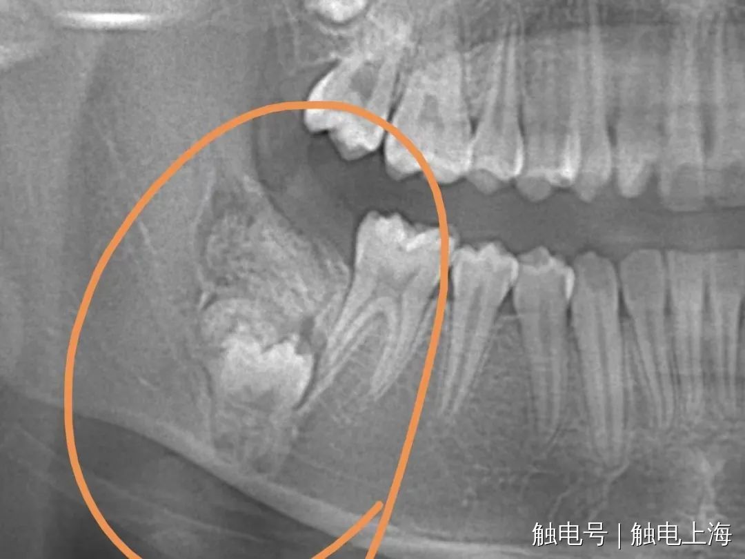 牙齿|口腔拍片发现异样阴影，牙齿也会有“肿瘤”？