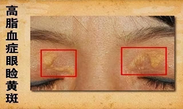 血脂高的人要远离豆腐?医生:不止豆腐,这4种素食也尽量远离