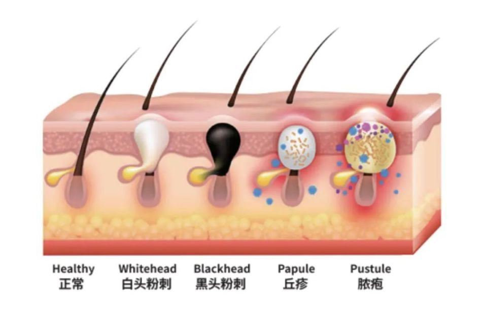 郭碧婷 皮防科普 | 怎么样拥有一张干净的脸？