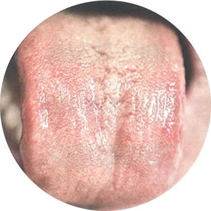 失眠|中医中的舌诊,了解吗