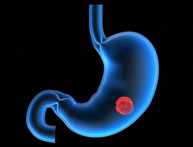 食物中的“奥美拉唑”,医生:每天坚持吃,或帮你养出“健康胃”