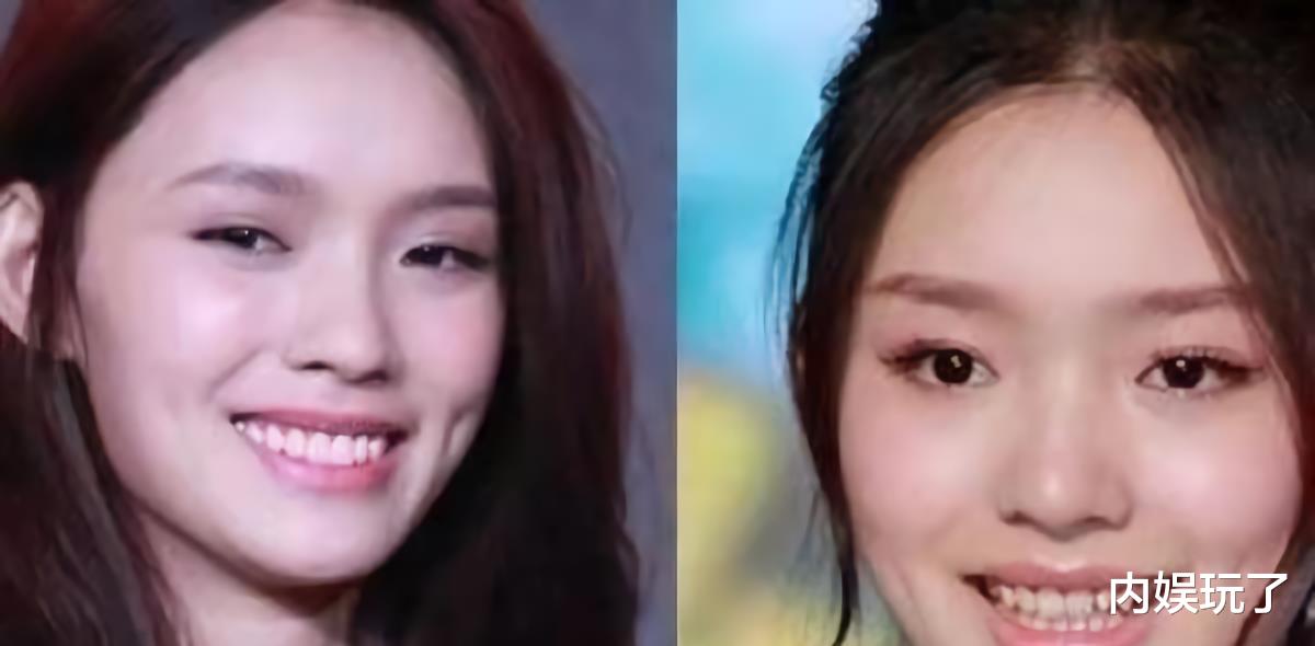 刘涛拔掉全部牙齿，花300万做烤瓷牙，如今她受了不该有的痛苦